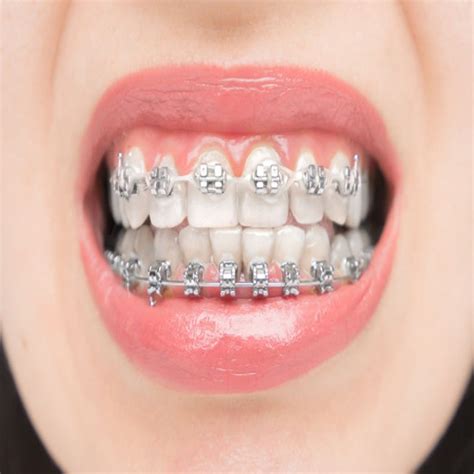 precio de bracket dental